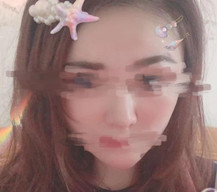 做完热玛吉已经有一周的时间