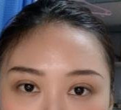 现在的心情很高兴，因为要拆线了