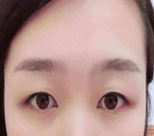 割了双眼皮后整个人气质都变得温婉了 