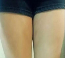 大腿吸脂真的可以让我拥有细长美腿耶