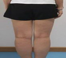 吸脂瘦大腿手术真奇妙,轻松甩掉多余脂肪