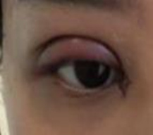 双眼皮加上开眼角 眼睛简直不要太大咧