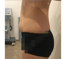 腰腹吸脂改善我的大肚腩