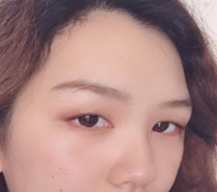 做了双眼皮后不再需要双眼皮贴
