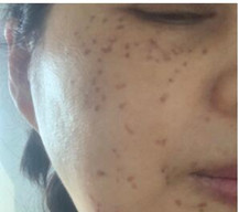 决定去做祛斑手术