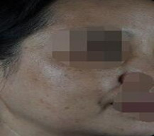 手术过程和术后感受