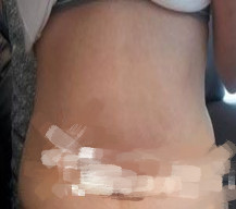 吸脂手术让我的身材越来越好