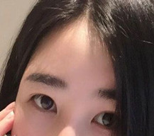 不喜欢单眼皮了，做了双眼皮效果很不错