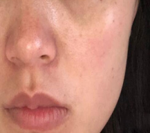 点阵激光做了之后皮肤超好