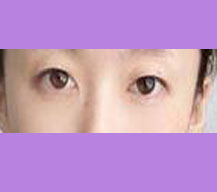 双眼皮手术后眼睛变得有神