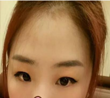 双眼皮后真的太减龄了，人也好看了