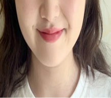 做瘦脸去咯