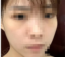 脂肪填充面部肉嘟嘟很可爱