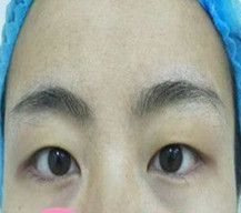 面诊医生给我的建议是做全切双眼皮手术