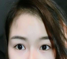 我就开始找医院做双眼皮修复