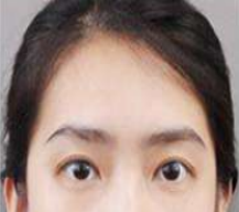 眼睛真的大了好多
