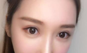 术后一个月拥有美丽的双眼皮
