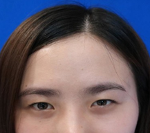 做了双眼皮好多小姐妹们都称赞我变漂亮了