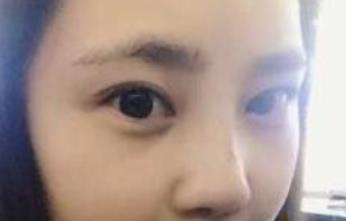 鼻子整形手术让我变美了