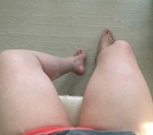 我来做了大腿环吸手术