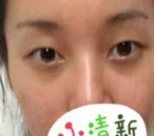 切开双眼皮手术日记分享给大家