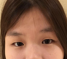 做过的双眼皮效果宛如天生，很好看