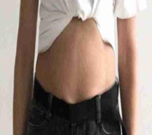 腰腹部吸脂手术让我拥有完美身材