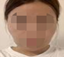 颧骨太大了怎么办