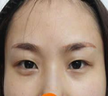 开了眼角后，眼睛深邃有神，越看越喜欢