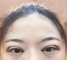 术后的眼睛肿胀