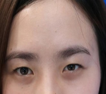 我的双眼皮恢复的非常理想，姐妹都夸我的眼睛变漂亮了许多呢