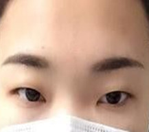 新做的双眼皮线条流畅柔和，我很喜欢呢