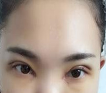 术后的肿胀还是很厉害的呢