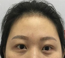 双眼皮+开眼角，朋友都说我变精神了许多