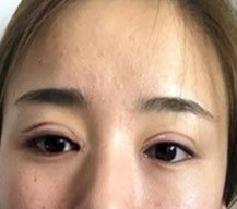 拆线后的双眼皮我很是满意呢