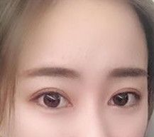 眼睛恢复的越来越自然了