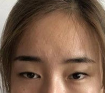 就说了双眼皮之后说宛如天生一点也不夸张