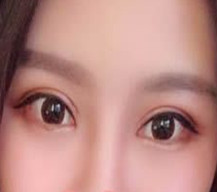 双眼皮的形状和宽窄我也很满意
