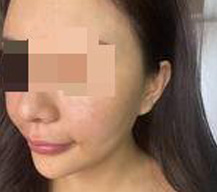 光子嫩肤手术打造美白的皮肤