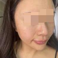 光子嫩肤手术后20天