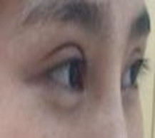 双眼皮失败后下决心做修复手术