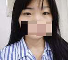 眼睛变美之全切双眼皮手术