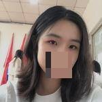 全切双眼皮术后1天