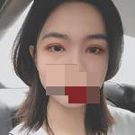 全切双眼皮术后32天