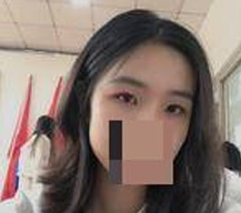 全切双眼皮手术后眼睛和以前不一样了