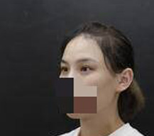 全切双眼皮手术眼睛越来越美