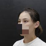 全切双眼皮手术当天
