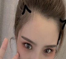 双眼皮失败修复手术让我重获新生