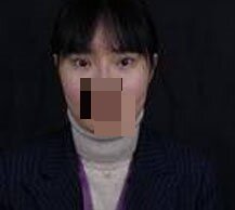 全切双眼皮手术后眼睛变得美丽无比