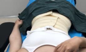 腰腹部吸脂手术后10天